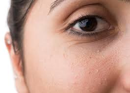 As the title of this blog states, milia are small white bumps that occur on the face, particularly around the eyelids, nose, mouth, and cheeks. The Ultimate Guide To Milia Under Eye Treatment Realself News