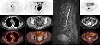 Although the percentage of cases in men is much lower than in women, male breast cancer accounts for a por. Clinical Verification Of 18f Dcfpyl Pet Detected Lesions In Patients With Biochemically Recurrent Prostate Cancer