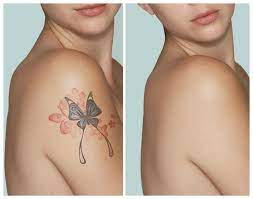 Surgical removal is the most invasive method of tattoo removal. Dreamtree Deals