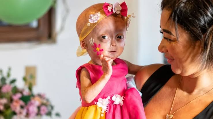 Elis, uma das gêmeas com síndrome rara de envelhecimento precoce, morre aos  cinco anos - NC News