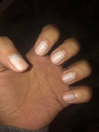 Image result for Muehrcke Line