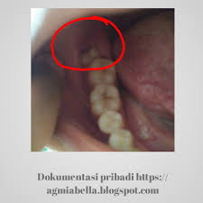 We did not find results for: Blog Emak Ketika Gigi Geraham Bungsu Tumbuh Tidak Muat Tempat Impaksi Gigi