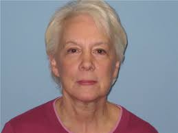 Facelift Before and After Photos by Paul Vanek, MD, FACS; Concord, OH