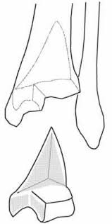 Fractures De La Cheville