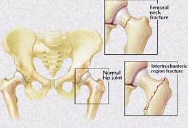 Each is made up of three. Hip Fracture Kirk Mendez M D Bone And Joint Specialists