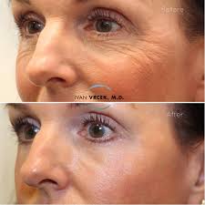 Timehop or surgery? 😉 Before & after a customized lower Blepharoplasty  with fat repositioning, a chemical peel, a skin pinch and Botox. Pictured  here 3 months after surgery. Botox and surgery can