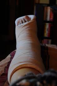 Broken Ankles 101 Broken Ankle Recovery Broken Ankle Ankle Fracture
