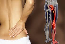 Muscle strains are a severe pulling or overextension of a muscle. Sciatica Pictures Symptoms Causes And Treatments