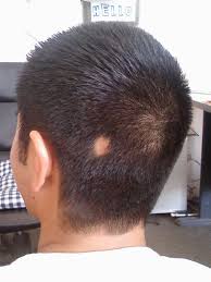 Alopecia areata is a form of alopecia (hair loss). Alopecia Symptoms Everything You Need To Know