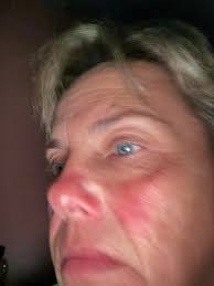 Treatment for lupus butterfly rash