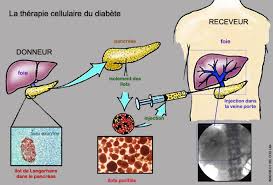 Certains symptômes du diabète de type 1 sont plus évidents que d'autres. Le Traitement Du Diabete De Type 1 Par Therapie Cellulaire Planet Vie