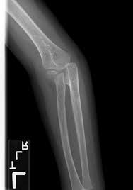 Image result for Radial Head Dislocation