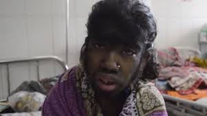 Werewolf syndrome is often mistaken for another condition known specifically as hirsutism. 12 Year Old Girl Suffers From Werewolf Syndrome Covered In Thick Black Hair