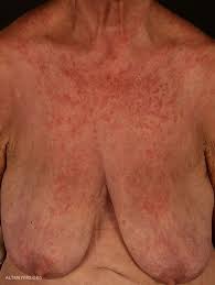 Oft ist auch die leber entzündet und wie evtl. Exanthem Altmeyers Enzyklopadie Fachbereich Dermatologie