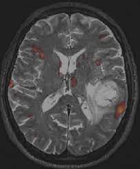 Glioblastoma Multiforme Symptoms Diagnosis And Treatment Options