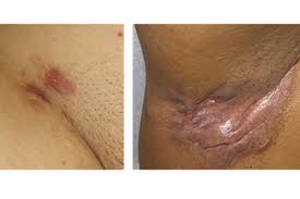 Image result for sore skin in the groin area