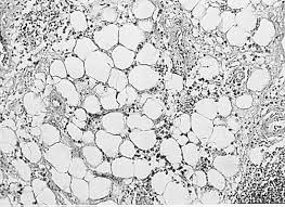 And new coverage of when and when not to use radioiodine in the treatment of patients with thyroid cancer. Graves Disease And The Manifestations Of Thyrotoxicosis Endotext Ncbi Bookshelf