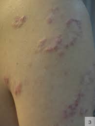 Image result for Secondary Syphilis
