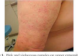 These include skin rashes, joint pain, and some. Evaluation Of Cutaneous Angioimmunoblastic T Cell Lymphoma Semantic Scholar