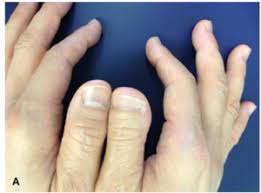 Toe Thumbs Up A Genetics Lesson Hidden In A Super Bowl Commercial The Genomicist