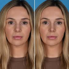 Anyone travel to Antalya Turkey instead of Istanbul? Most of the surgeons  I've researched are in Istanbul but one I'm seriously considering is in  Antalya. Can anyone share their experience? I'm coming