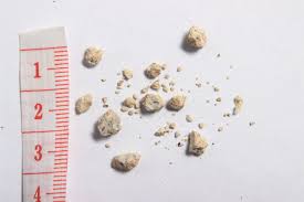 Small Kidney Stones Kidney Stone Treatment Urologist Urology Austin