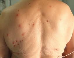Image result for scabies human bites