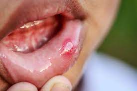Are Mouth Ulcers Caused By Allergies Allergies And Health