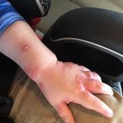 Image result for Fire Ant Sting