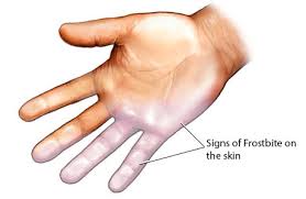 Frostbite can happen in just a few minutes or can take as long as an hour or two, depending on the frostbite is the freezing of the skin and tissue. Frostbite Norway Pdf Ppt Case Reports Symptoms Treatment