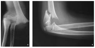 The distal humerus's supracondylar area in children. Jfmk Free Full Text Surgical Treatment Of Displaced Supracondylar Pediatric Humerus Fractures Comparison Of Two Pinning Techniques Html
