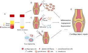 Schematic diagram of PRP in the treatment of articular cartilage ...