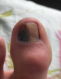 Image result for Acral lentiginous melanoma nail