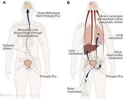 Like other cancers, prostate cancer can spread (metastasis) from the site of where it first started to other sites of the body. How Often Does Prostate Cancer Spread To The Liver