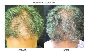 Microneedling can help with hair loss and alopecia by releasing endothelial growth factor that promotes the growth of hair, increases follicile size and promotes thicker hair. Prp Microneedling And Hair Restoration New York City Manhattan Ny