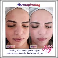 Dermaplanig é um Peeling mecânico superficial para remoção e renovação da  camada córnea. E uma esfoliação superficial, em que é feita uma ablação com  uma lâmina de bisturi, removendo a camada córnea (