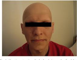 Complete or extensive hair loss on most parts of body, called alopecia totalis or universalis is not. Figure 1 From Pernicious Anemia In A Patient With Type 1 Diabetes Mellitus And Alopecia Areata Universalis Semantic Scholar
