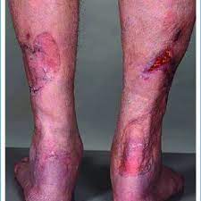 Durch infektiöse, immunologische oder angiologische ursachen entstehen. Pdf Ulcus Hypertonicum Martorell