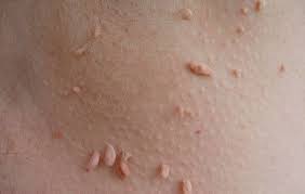 reklamlar skin tag skin home remedies