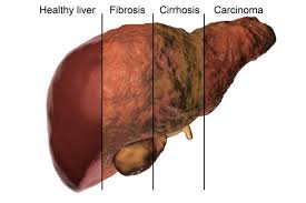 Liver cirrhosis treatment