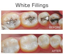 At your dentist's office, you can discover options such as: Tooth Colored Composite Fillings In Glen Mills Pa Dr Mccoy