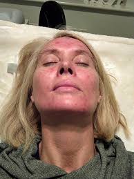 Day 9 I've a new red beard today...