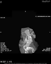 Take exit 62, at the end of the exit ramp go straight into the plaza at buckland hills. Medpix Case Abdominal Aortic Aneurysm Aaa