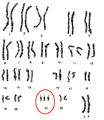 Gene Therapy For Down Syndrome Mmg 233 2014 Genetics Genomics Wiki Fandom
