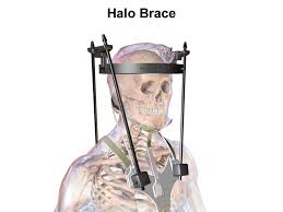 Halo Brace After A Spinal Cord Injury Why Are They Used Sci Progress