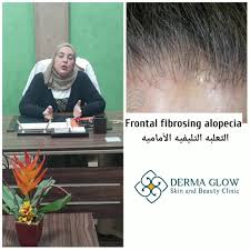 Alopecia areata causes hair loss, mostly in small, round patches. Frontal Fibrosing Alopecia Derma Glow Dr Rania Ramdan
