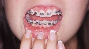 When you got braces, how painful was it when they pulled out the spacers and how long did the whole process take? Adult Braces Why Are More Grown Ups Getting Their Teeth Straightened Bbc News