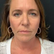 Face Before & After Photos