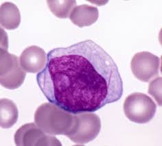 Leukaemia is the most common childhood malignancy accounting for approximately 30% of cases. Acute Myelogenous Leukemia Aml Oncology Medbullets Step 1
