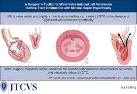 Image result for Left Ventricular Outflow Obstruction